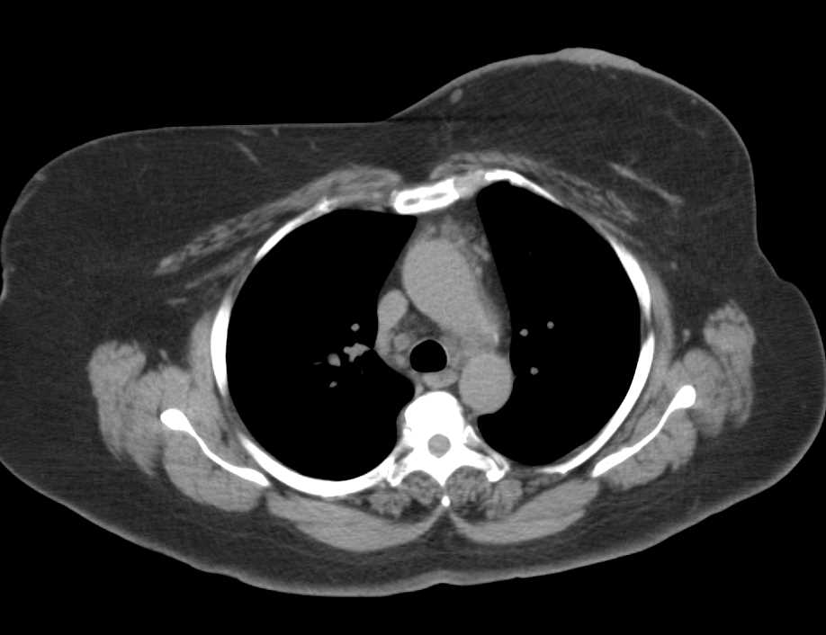 Multiple Pulmonary Emboli (PEs) in a Breast Cancer Patient - CTisus CT Scan