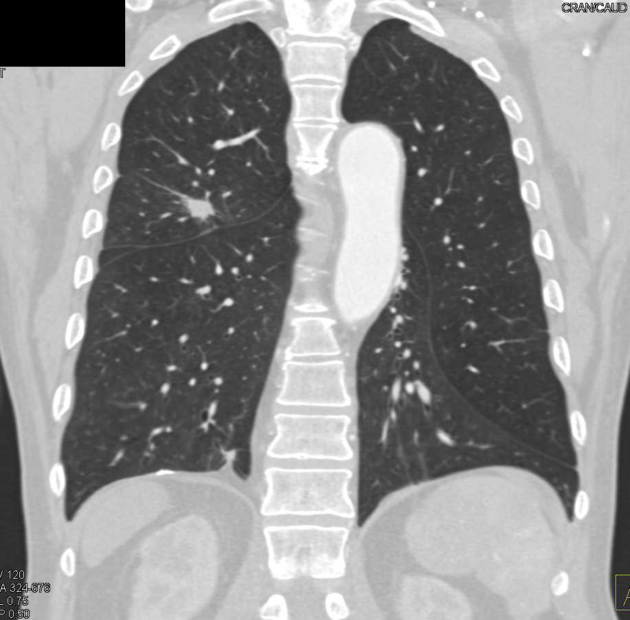 Incidental Scar Carcinoma Right Lung - CTisus CT Scan