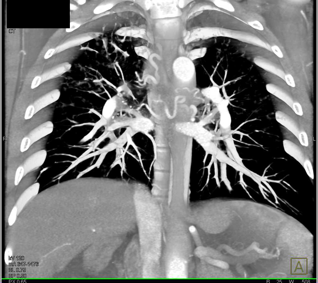 Cystic Fibrosis - CTisus CT Scan