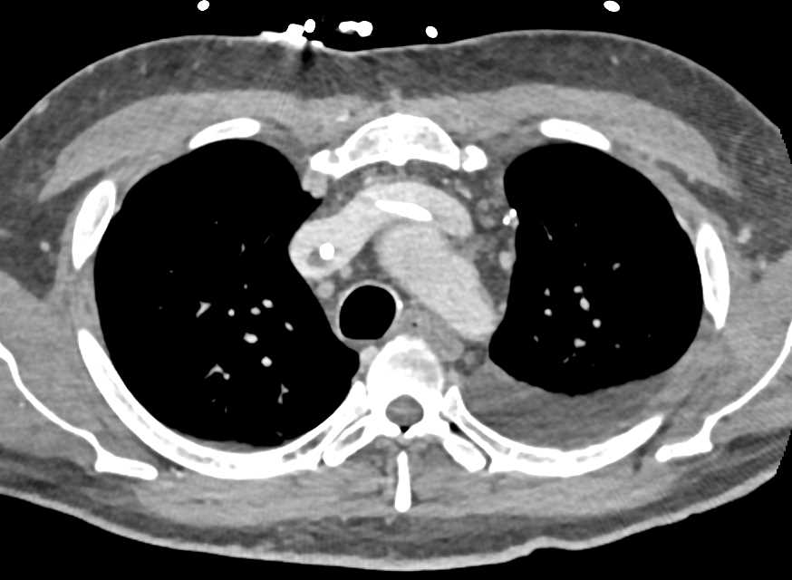 Multiple Clots Including Superior Vena Cava (SVC), and Left Atrium - CTisus CT Scan