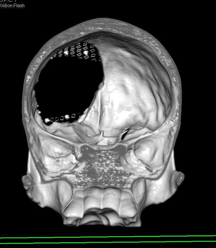 Multiple Pulmonary Emboli (PEs) in a Patient Post Cranial Surgery - CTisus CT Scan