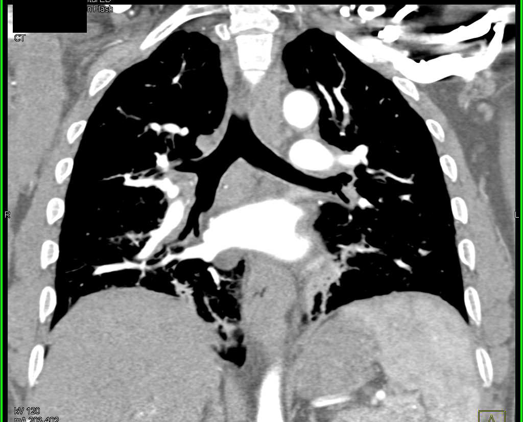 Air Trapping in the Lung with A Mosaic Pattern - CTisus CT Scan