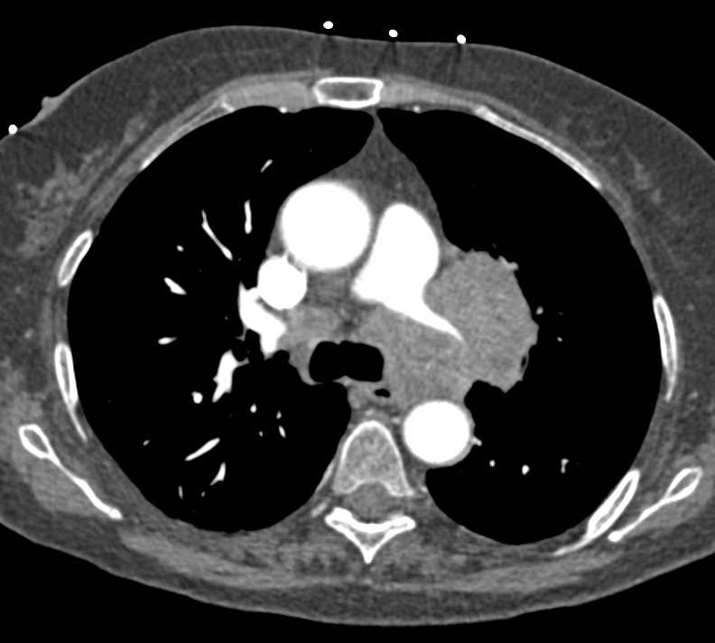 Non-Small Cell Lung Cancer (NSCLC) Encases the Pulmonary Artery and Adrenals and Adenopathy - CTisus CT Scan