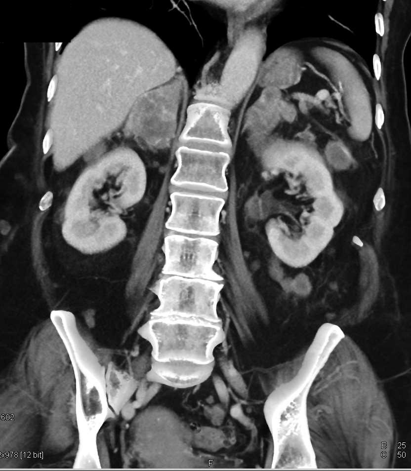 Metastatic Melanoma with Sites Including Left Hilum, Adrenal Glands and Adenopathy - CTisus CT Scan