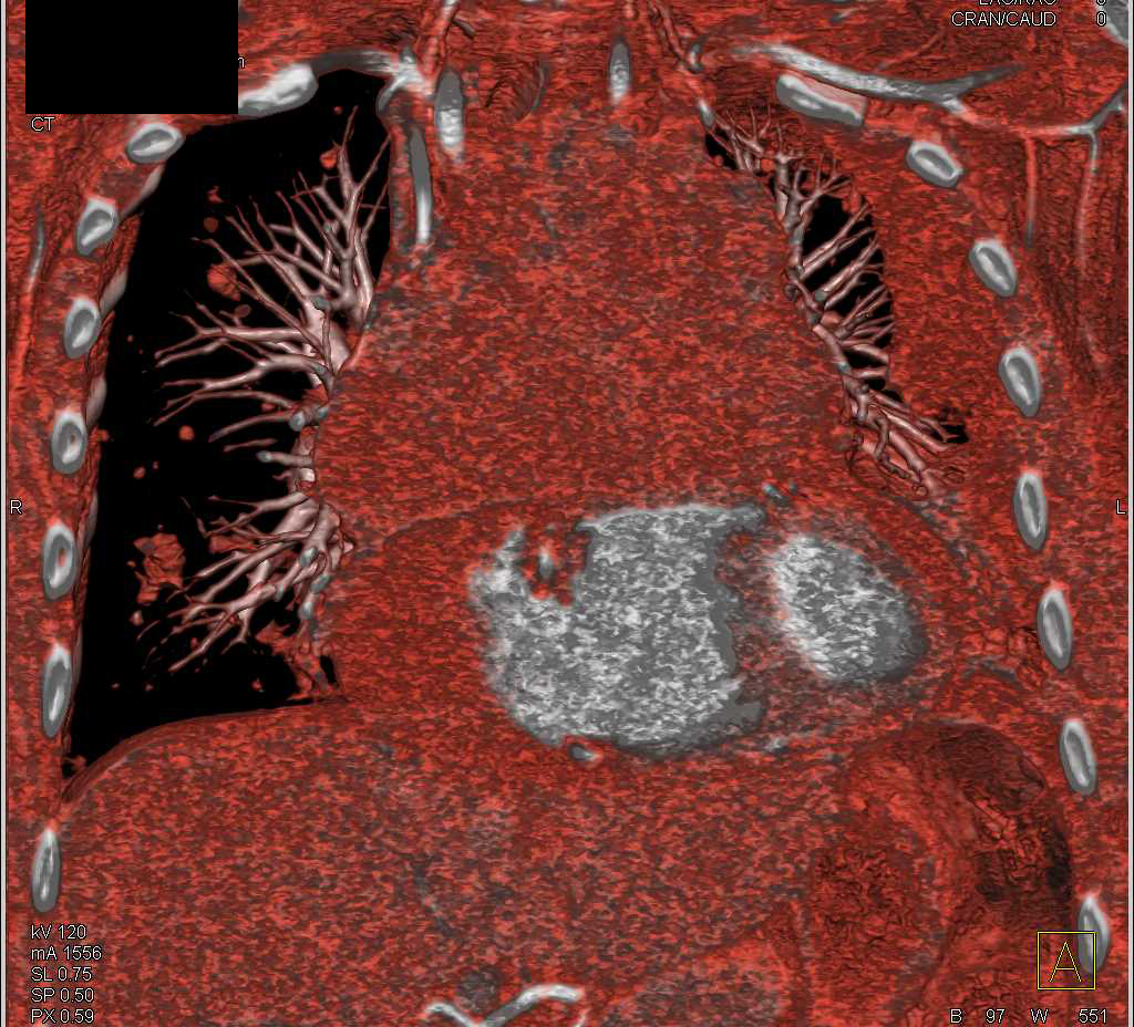 Lymphoma Anterior Mediastinum - CTisus CT Scan