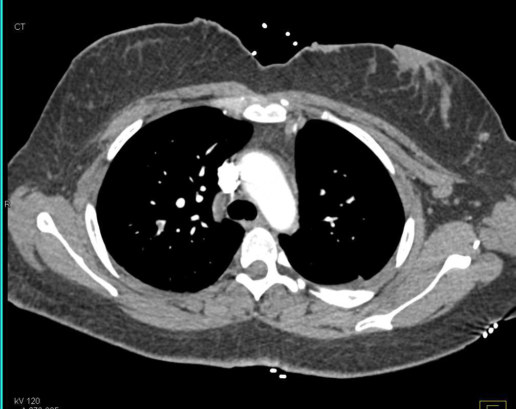 Pulmonary Embolism with Infarction also in Right Kidney - CTisus CT Scan