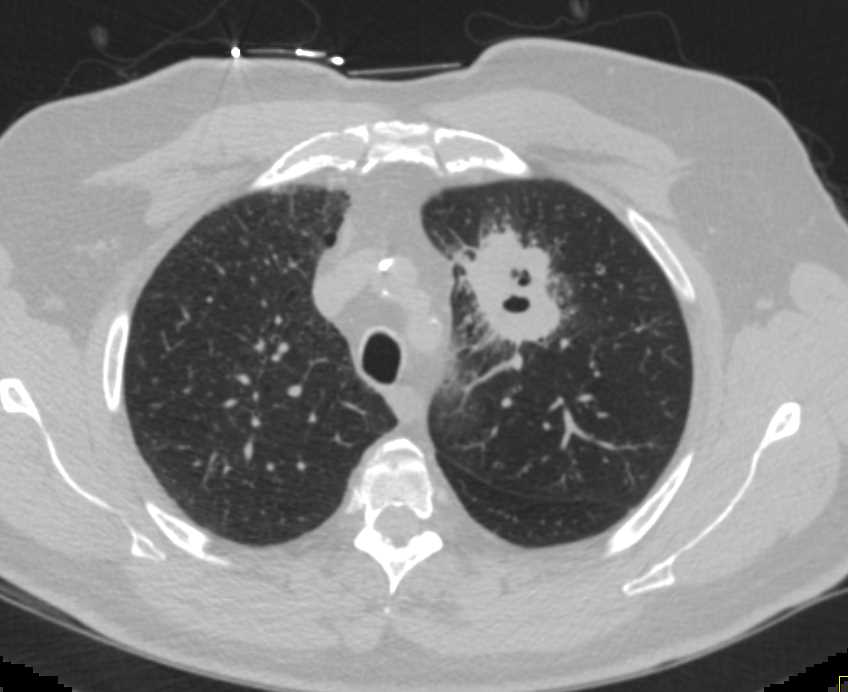 Lung Cancer with Renal Metastases - CTisus CT Scan