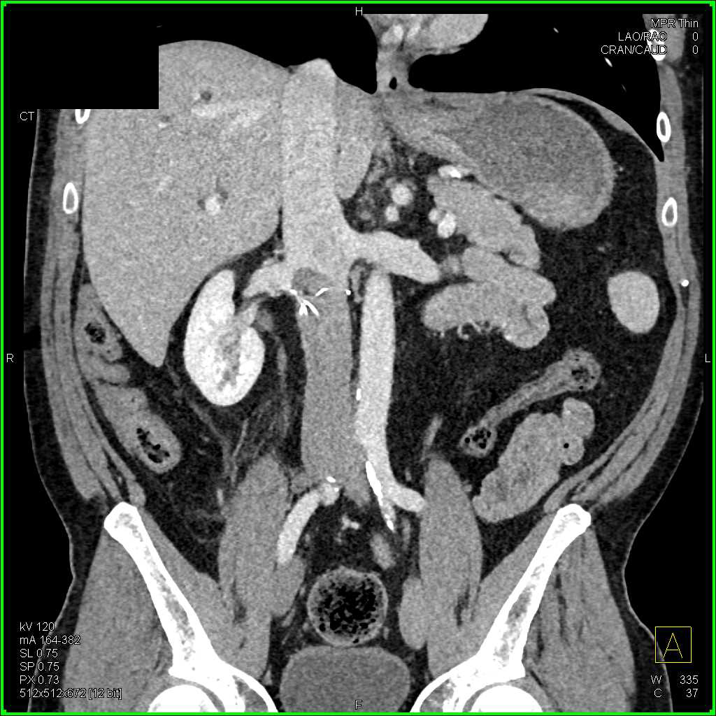 Pulmonary Embolism and Inferior Vena Cava (IVC) Thrombus - CTisus CT Scan