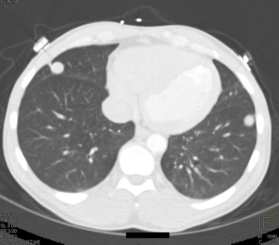 Metastatic Renal Cell Carcinoma to the Lungs - CTisus CT Scan