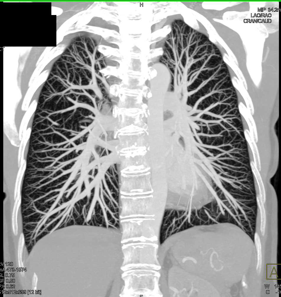 Pulmonary Arteriovenous Malformation (AVM) with Prior Embolization As Well - CTisus CT Scan