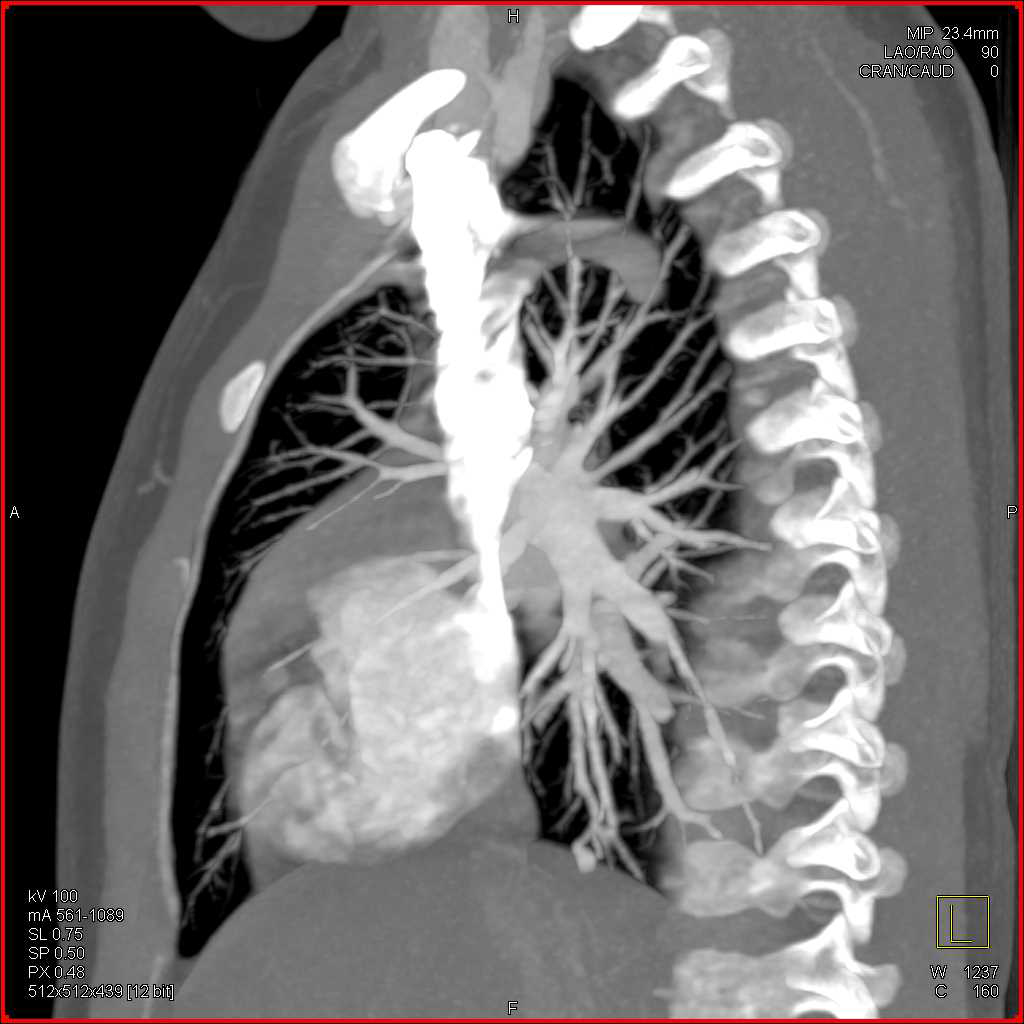 MIP Best Defines Subtle Pulmonary Arteriovenous Malformations (PAVMs) - CTisus CT Scan