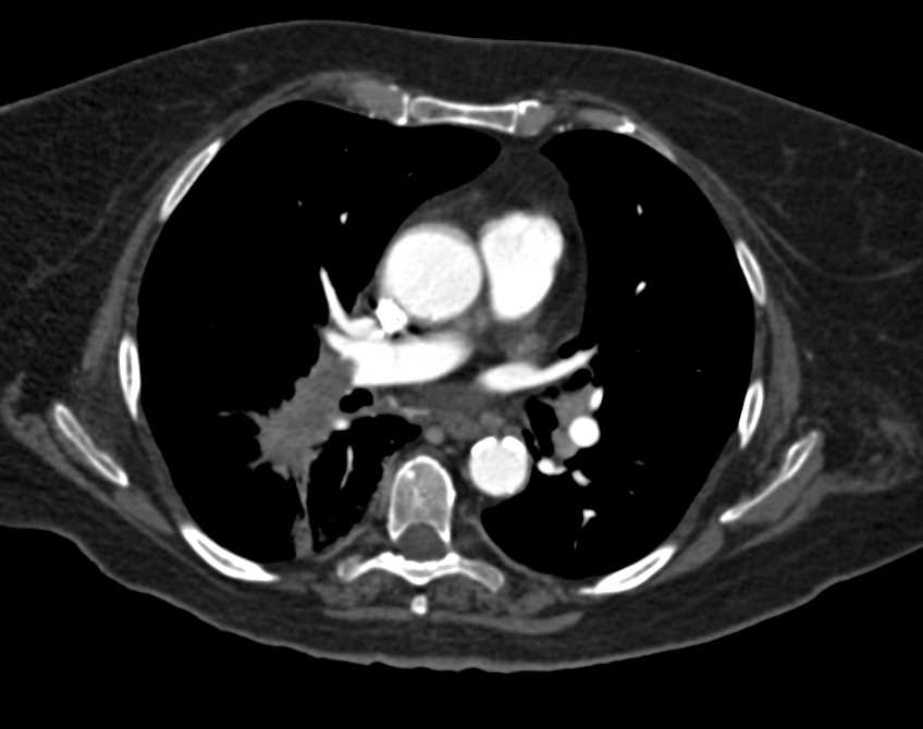 Lung Cancer Invades the Pulmonary Artery with Distant Embolism in Veins - CTisus CT Scan