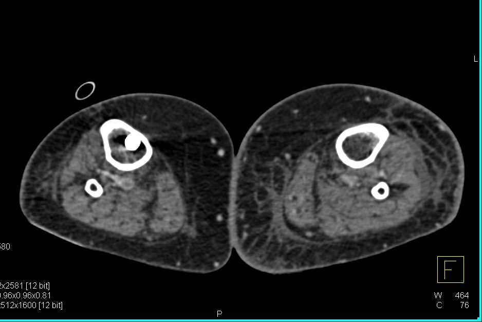 Lung Cancer Invades the Pulmonary Artery with Distant Embolism in Veins - CTisus CT Scan