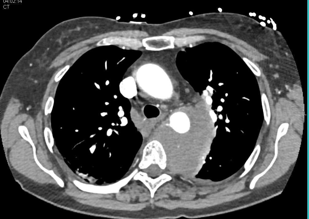 Tumor Infiltrates the Posterior Mediastinum and Encases the Aorta - CTisus CT Scan