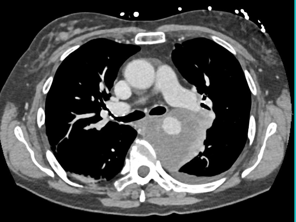 Tumor Infiltrates The Posterior Mediastinum And Encases The Aorta