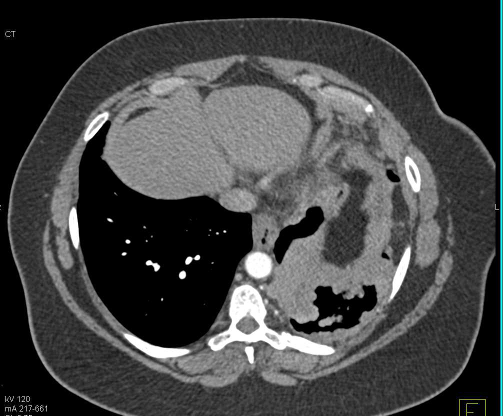 Lung Cancer with Left Pleural Implants with Metastases to the Pelvis - CTisus CT Scan