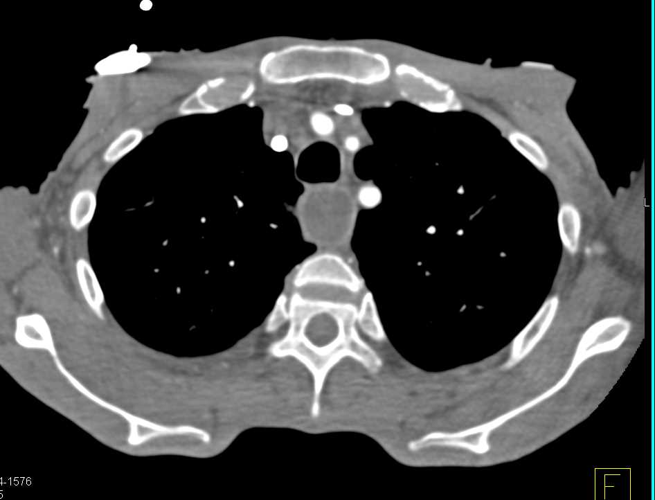 Esophageal Obstruction by a Sarcoma Near Diaphragm - CTisus CT Scan