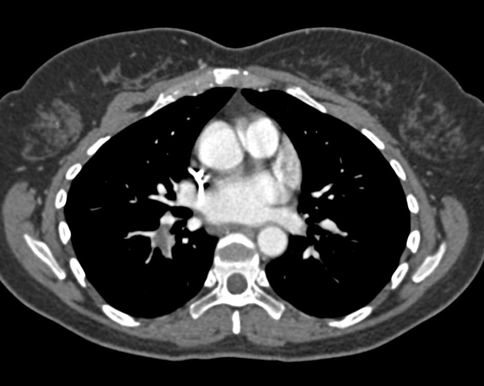 Incidental Pulmonary Embolism in a Patient with Gastric Cancer - CTisus CT Scan