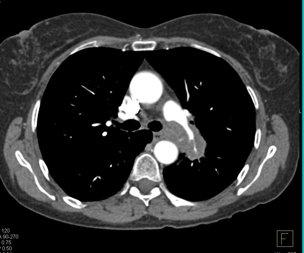 Non-Small Cell Lung Cancer (NSCLC) Encases the Pulmonary Artery and Lung Mass - CTisus CT Scan