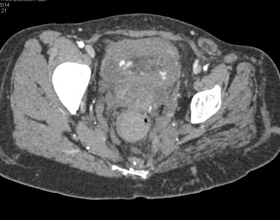 Klippel Trenaunay Weber (KTW) with Splenic Hemangiomas and Soft Tissue Hemangioma, Postpartum - CTisus CT Scan