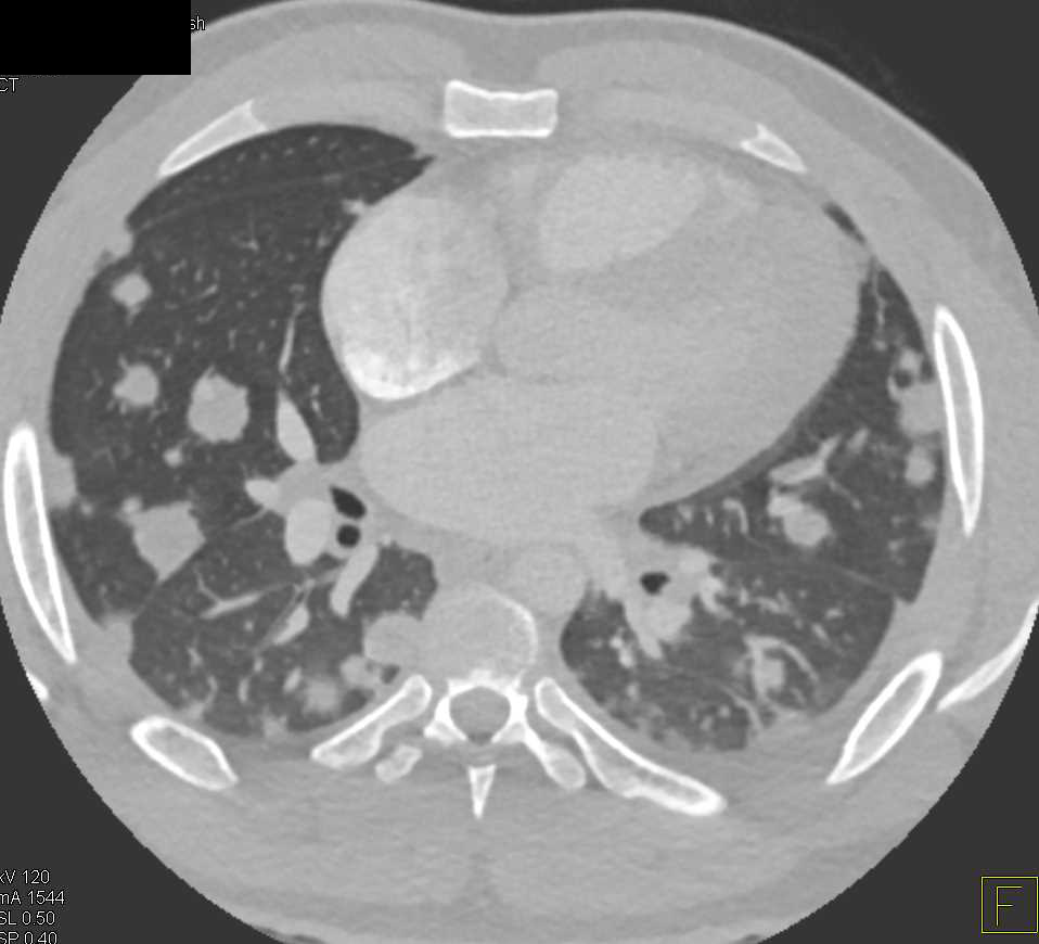 Multiple Hematogenous Lung Metastases - CTisus CT Scan