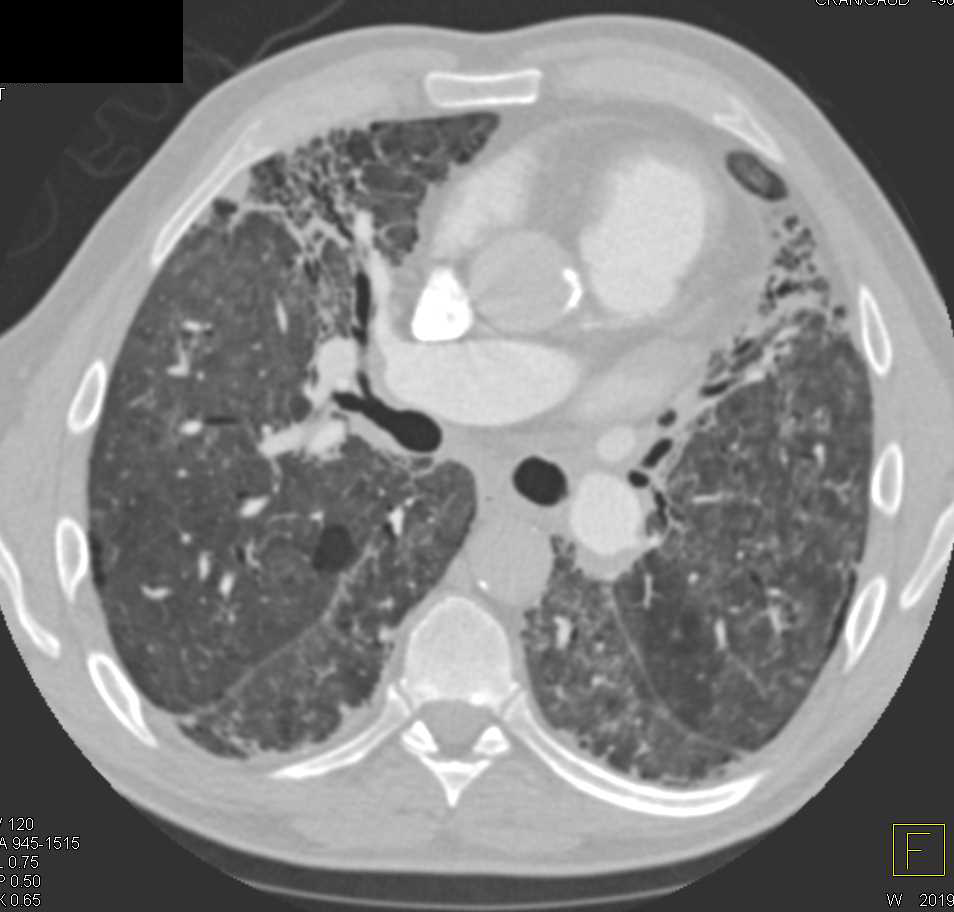 Interstitial Fibrosis and Superimposed Viral Pneumanitis - CTisus CT Scan