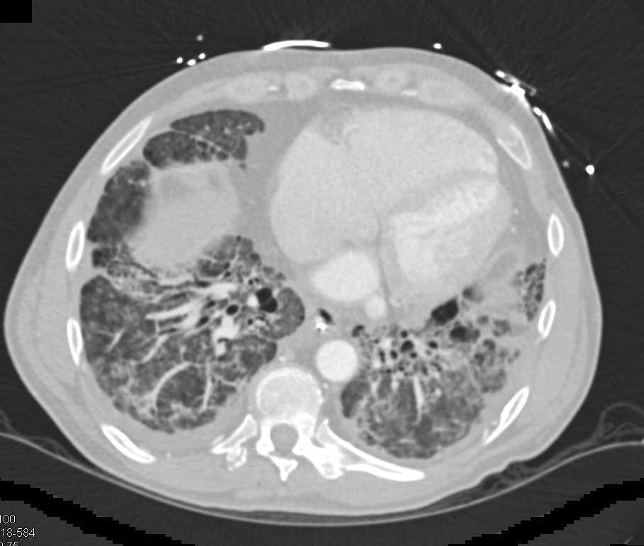 Interstitial Fibrosis and Vascular Disease - CTisus CT Scan