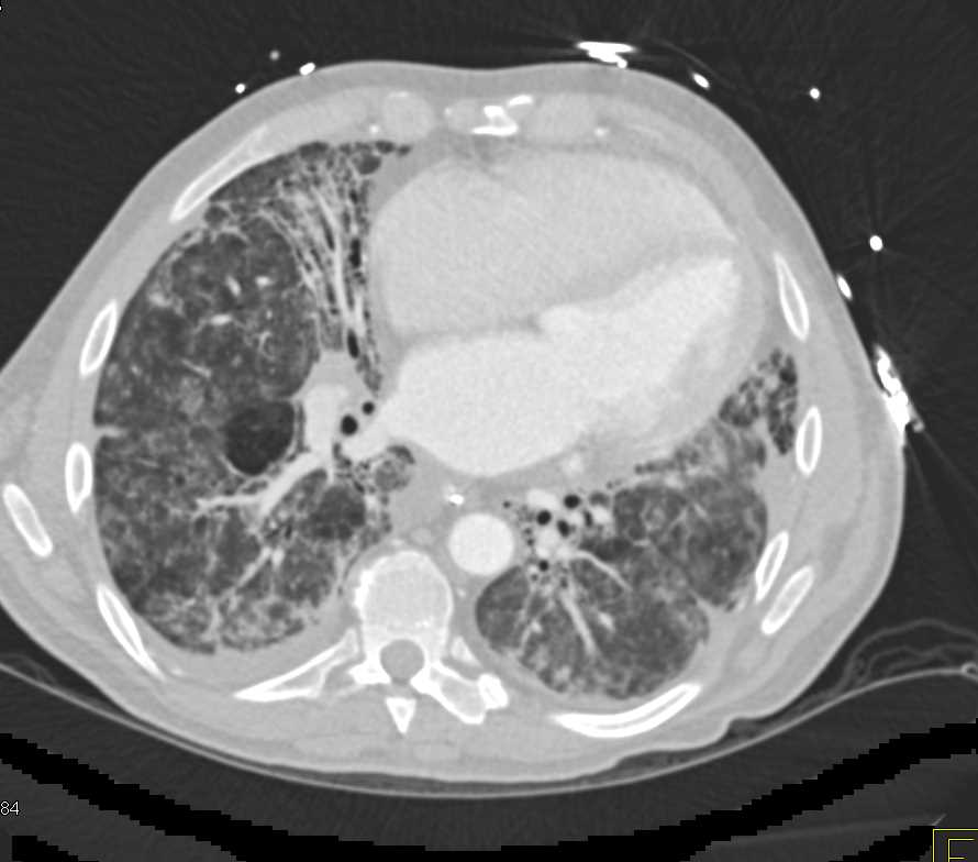 Interstitial Fibrosis Lung and Peripheral Vascular Disease - CTisus CT Scan