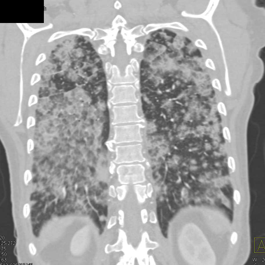 Diffuse Alveolar Infiltrates due to Hemorrhage - Chest Case Studies