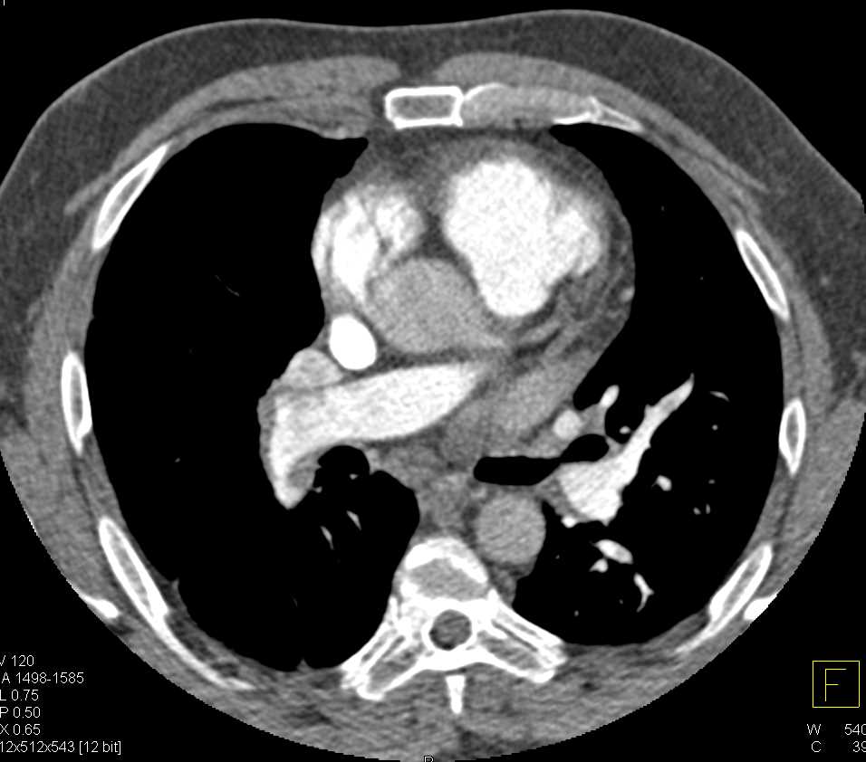 Pulmonary Embolism - CTisus CT Scan