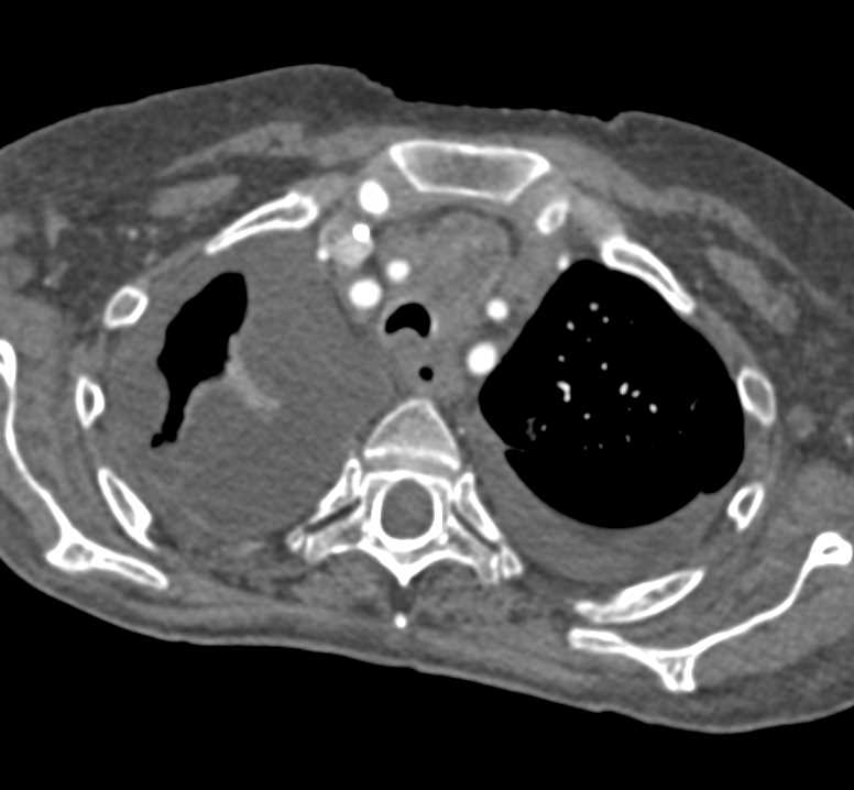 Located Right Pleural Effusion - CTisus CT Scan