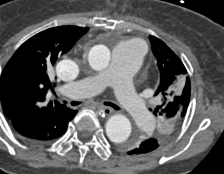 Pulmonary Artery Pseudoaneurysm - CTisus CT Scan