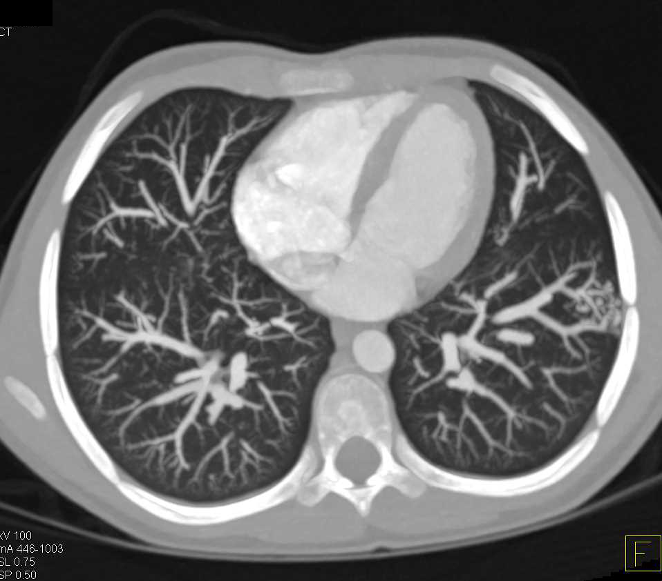 Pulmonary Arteriovenous Malformation (AVM) in Left Lower Lung - CTisus CT Scan