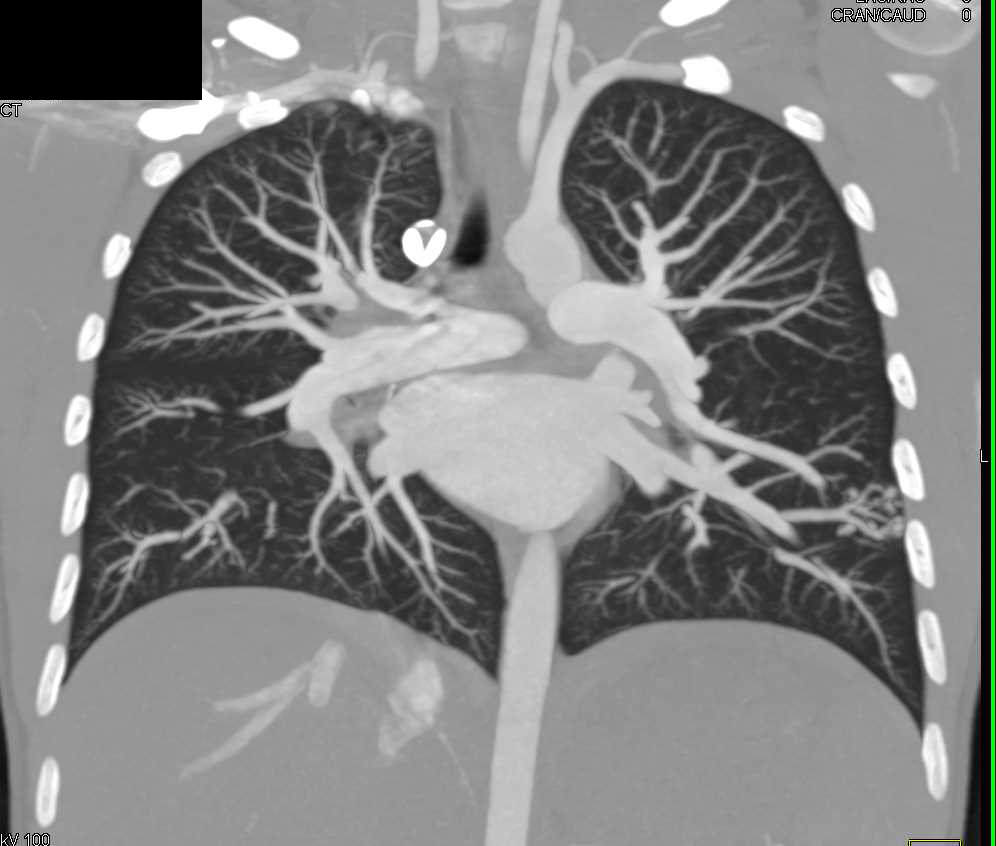 Pulmonary Arteriovenous Malformation (AVM) in Left Lower Lung - Chest