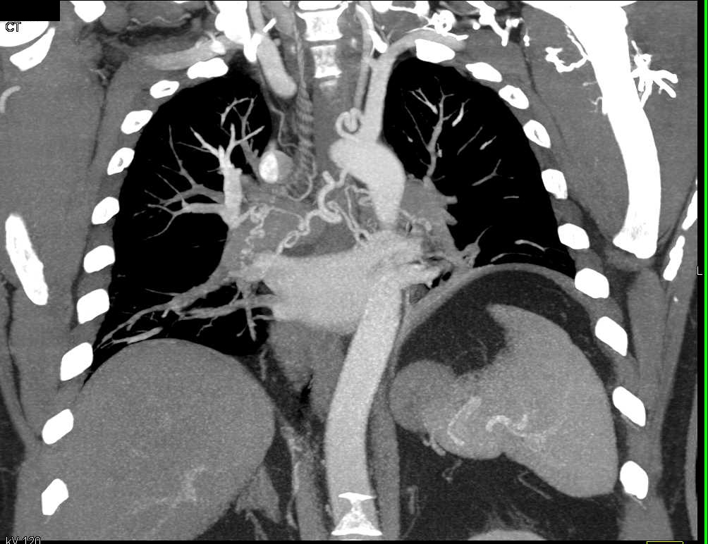 Occlusion Descending Thoracic Aortic Occlusion with Collaterals - CTisus CT Scan