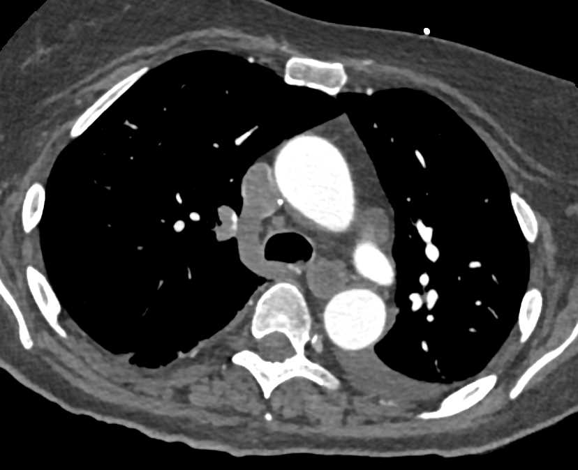 Thrombus in the Left Atrial Appendage and Pulmonary Embolism - CTisus CT Scan