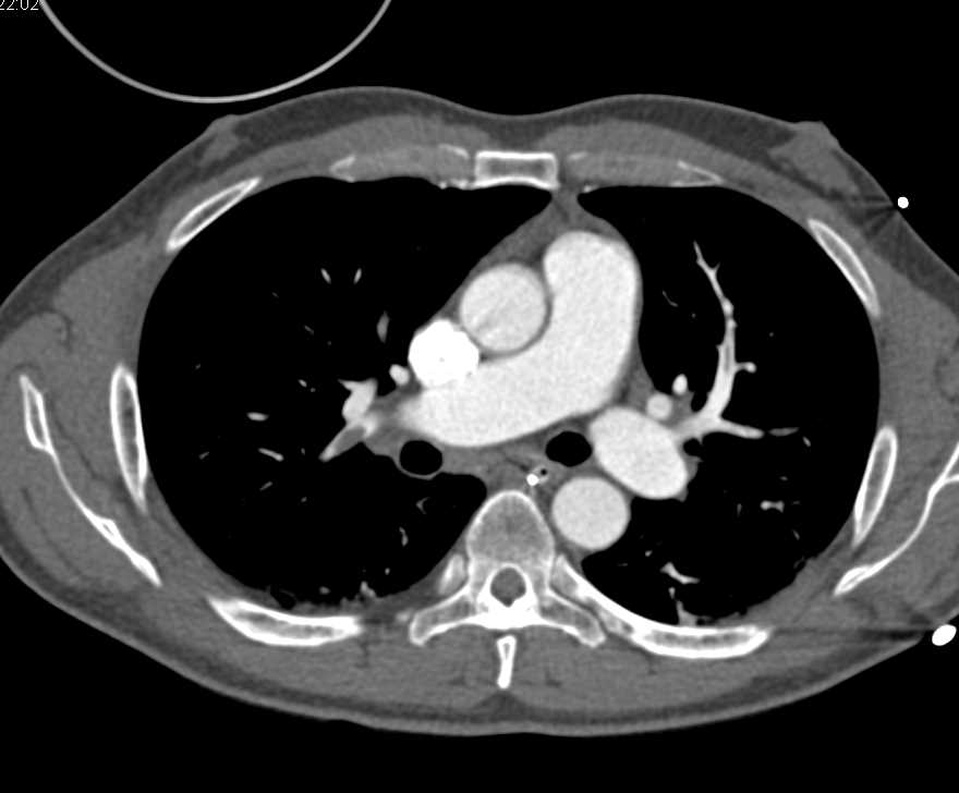 Multiple Bilateral Pulmonary Embolism - CTisus CT Scan