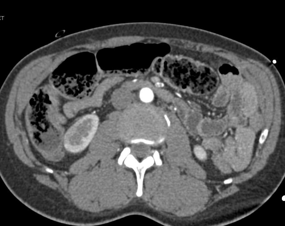 Pulmonary Embolism with Rectal Impaction - CTisus CT Scan