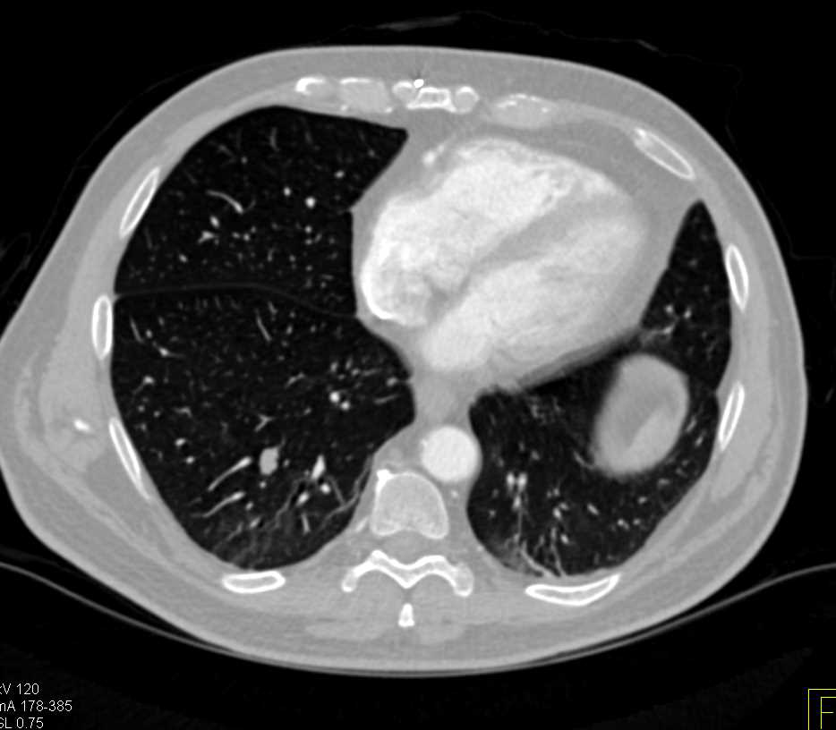 Lung Metastases from Pancreatic Adenocarcinoma - CTisus CT Scan