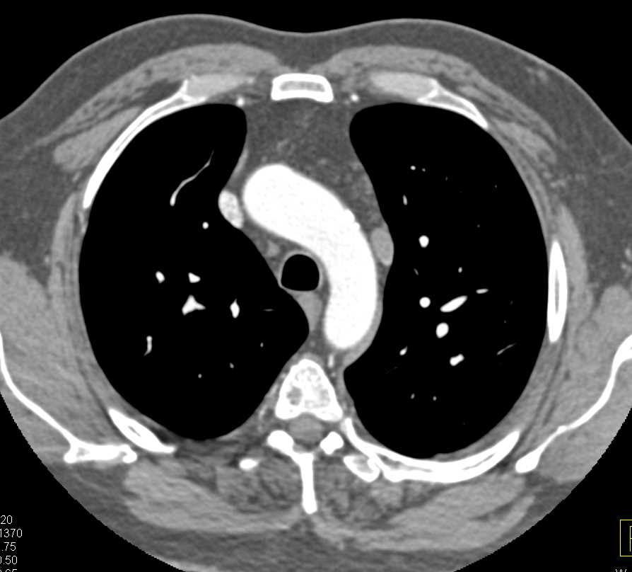 Persistent Left superior vena cava (SVC) with Solitary Left Kidney - CTisus CT Scan