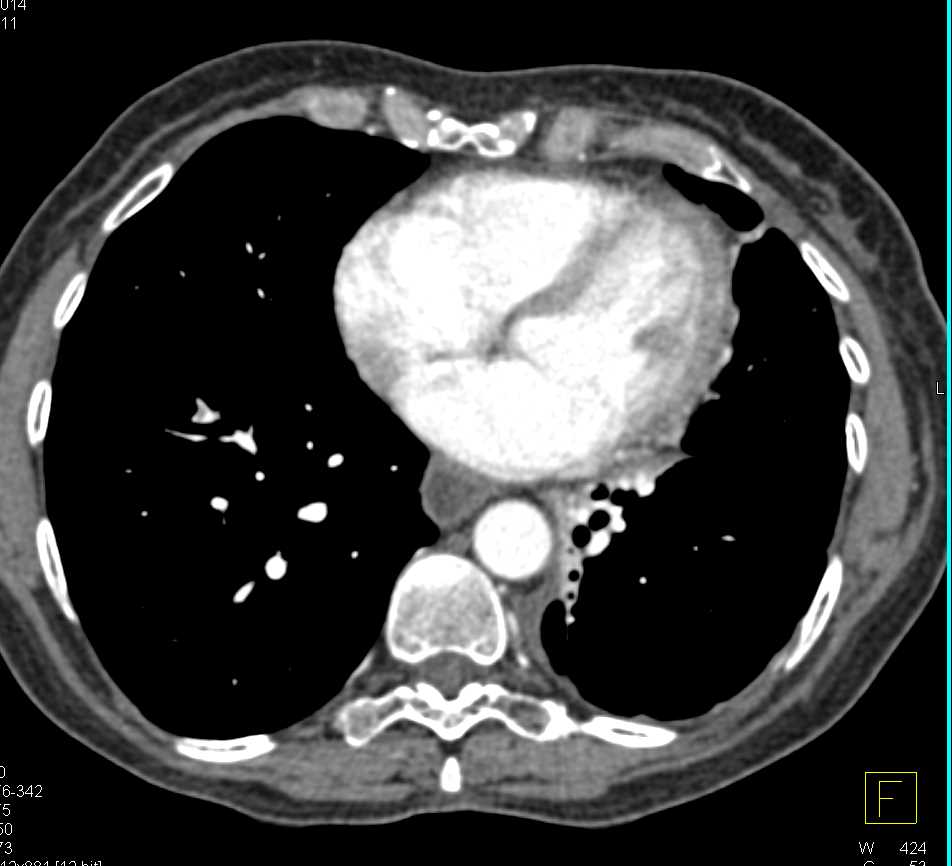 Subtle Pulmonary Embolism (PE) to Right Lower Lung - CTisus CT Scan