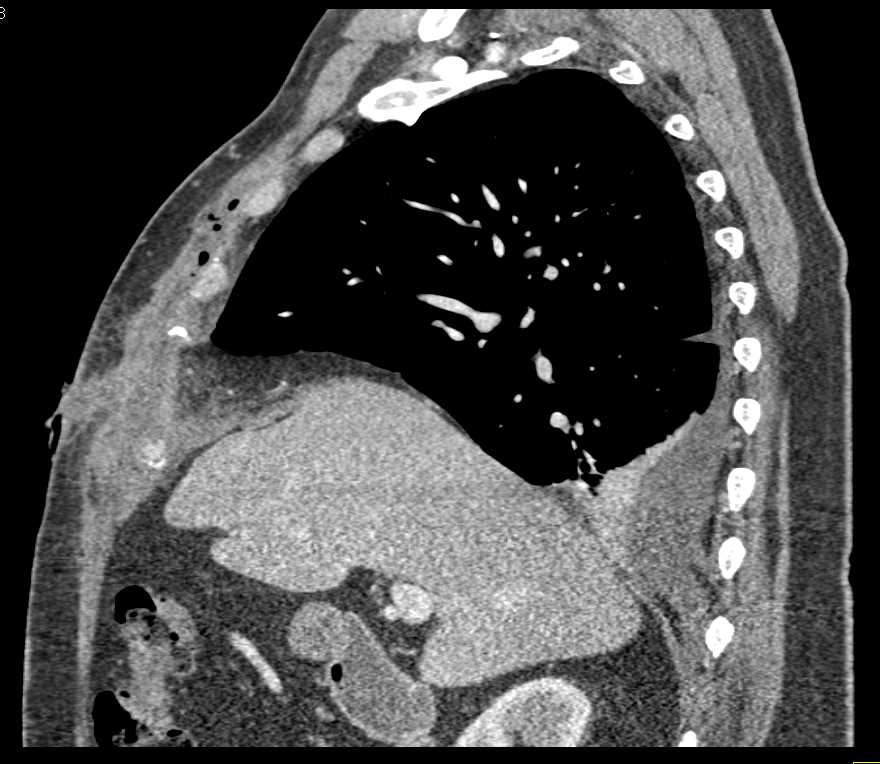 Infection in Right Chest Wall - CTisus CT Scan