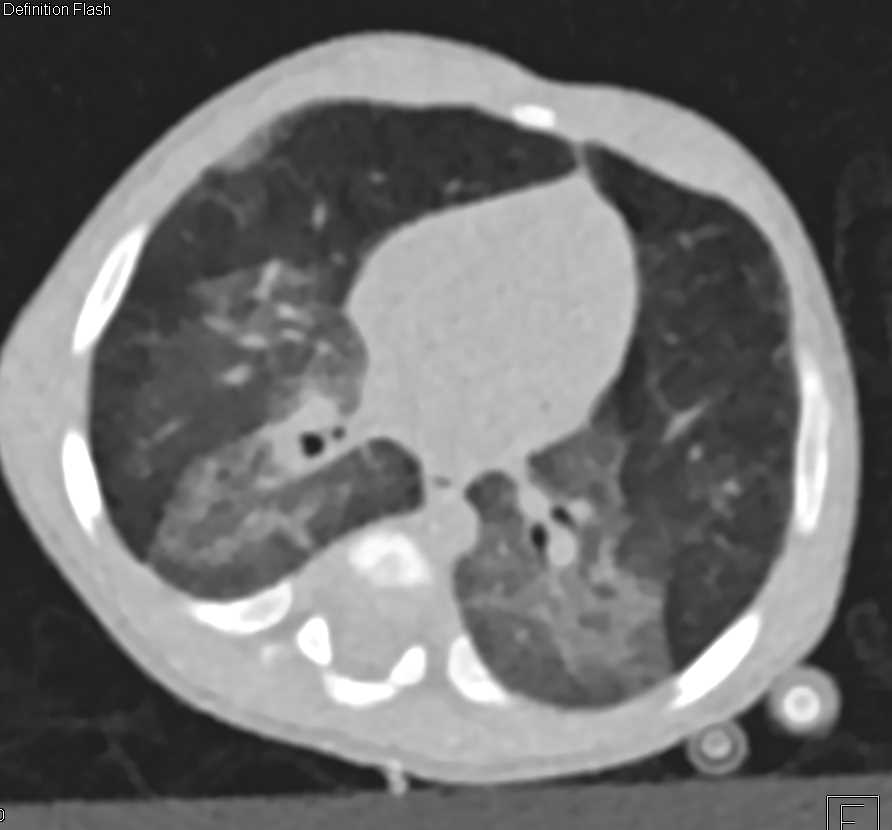 Patchy Ground Glass Infiltrates - CTisus CT Scan