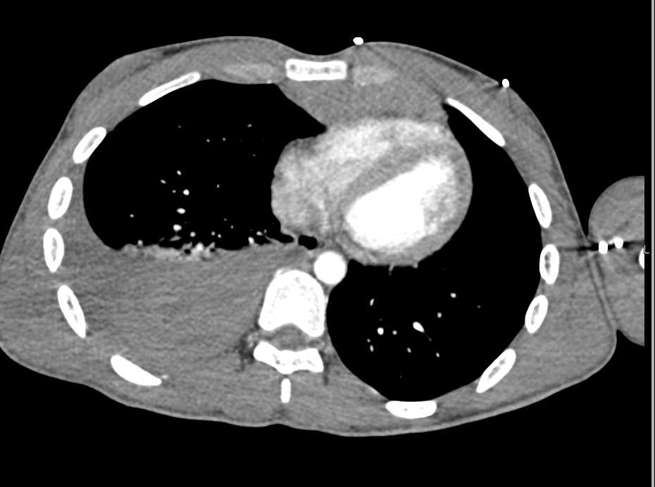 Large Right Hemothorax - CTisus CT Scan