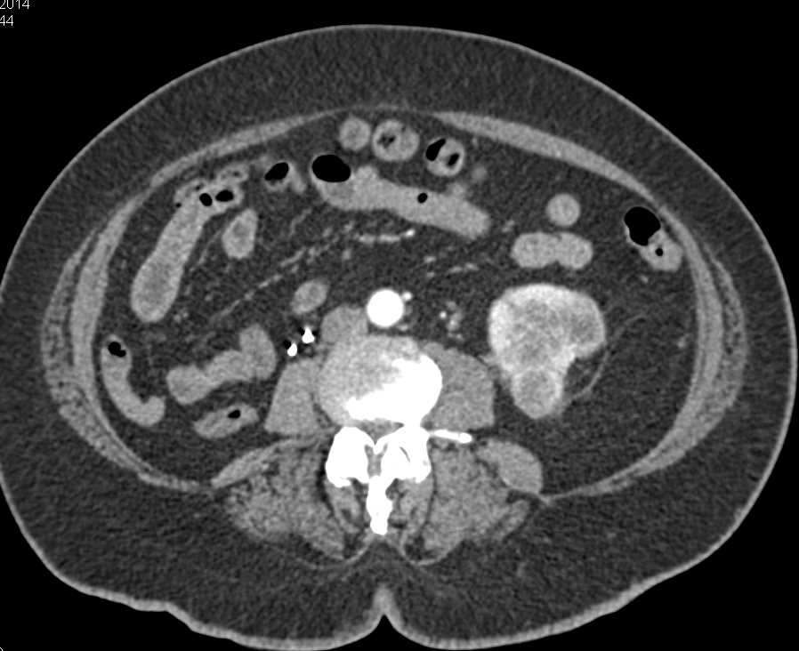 Metastatic Renal Cell Carcinoma to the Chest and Abdominal Sites - CTisus CT Scan