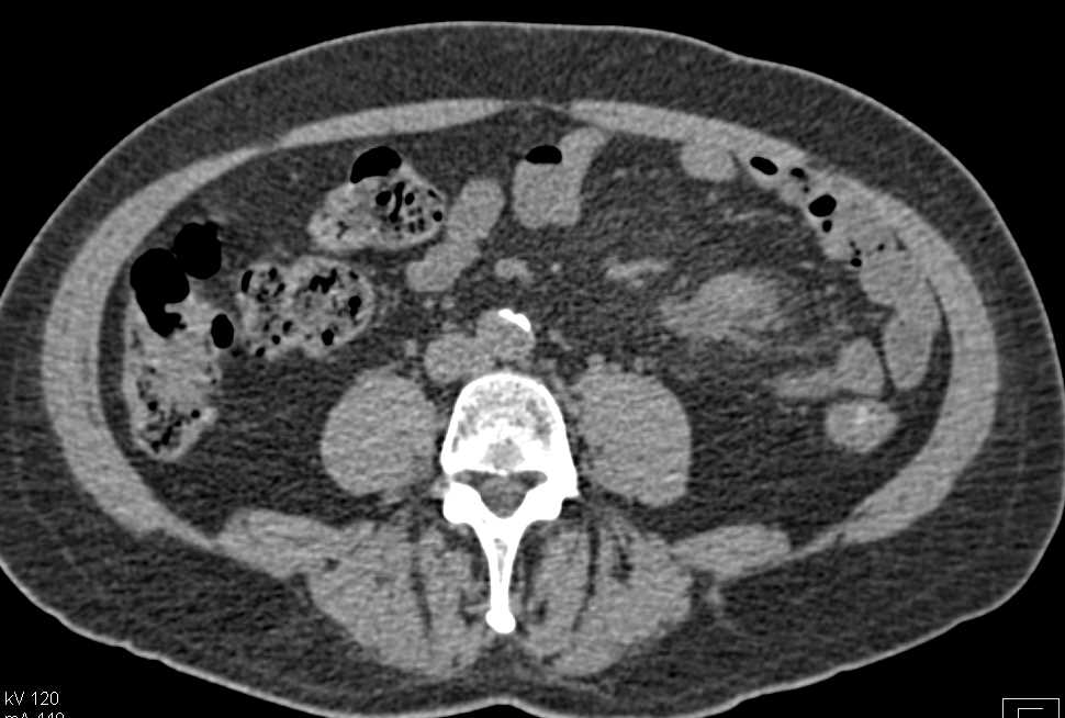 Carcinoid Tumor in Root of the Mesentery - CTisus CT Scan