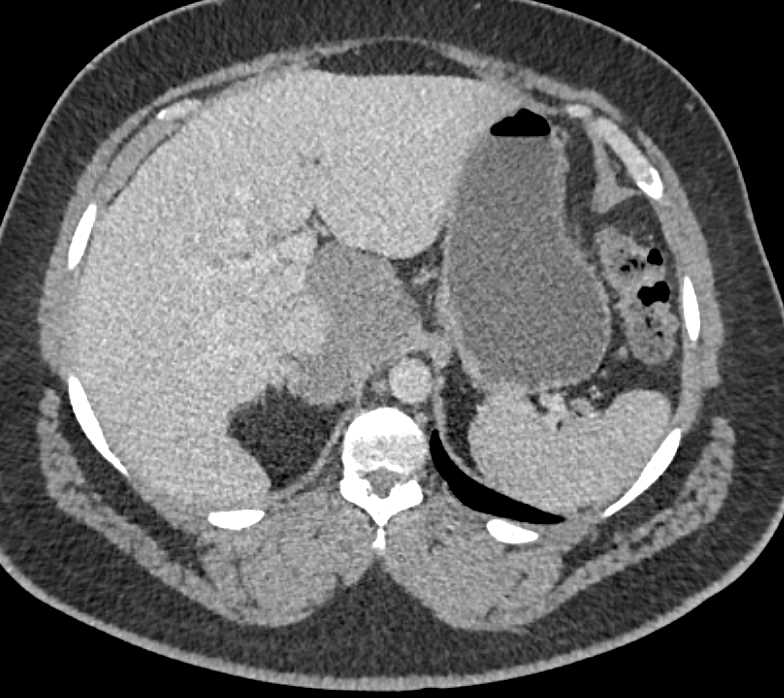 Incidental Thymoma in Patient with Extensive Adenopathy - CTisus CT Scan