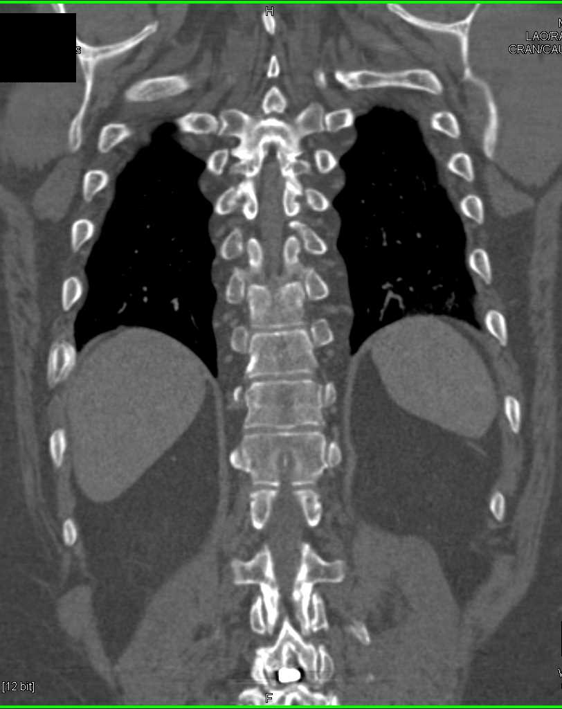 3D of the Ribs and Spine - CTisus CT Scan