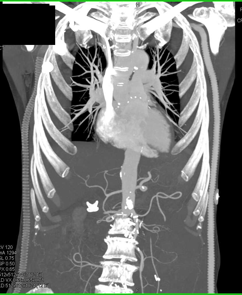 Occluded Right Axillary-Femoral Graft and Patent Left Axillary-Femoral Graft - CTisus CT Scan