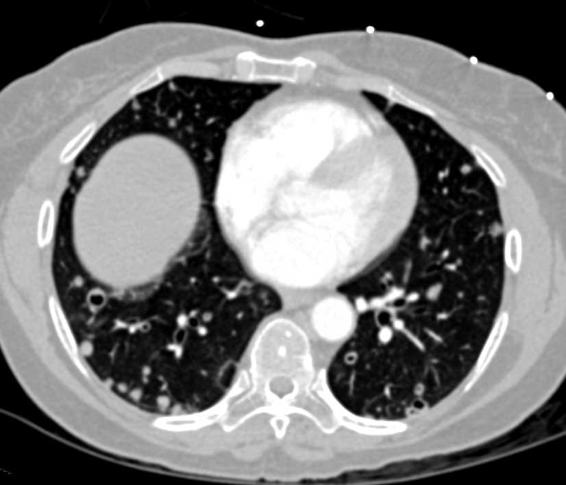 Carcinomatosis with Cavitary Lung Lesions - CTisus CT Scan